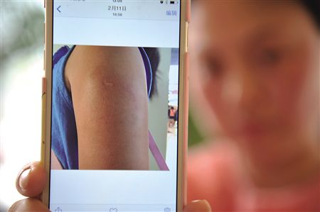 男导游亲吻女童遭拒绝被咬伤 肚子手臂红肿