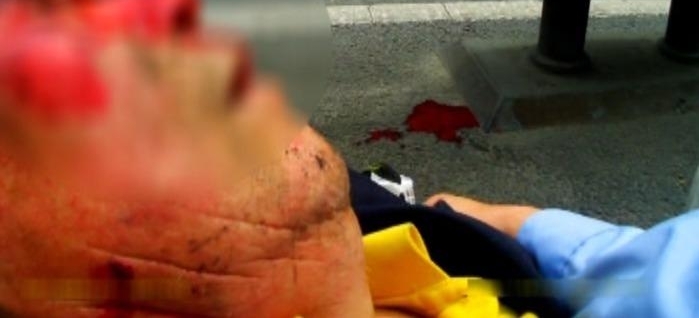 ������綯��ˤ����ͷ��Ѫ ��:����������