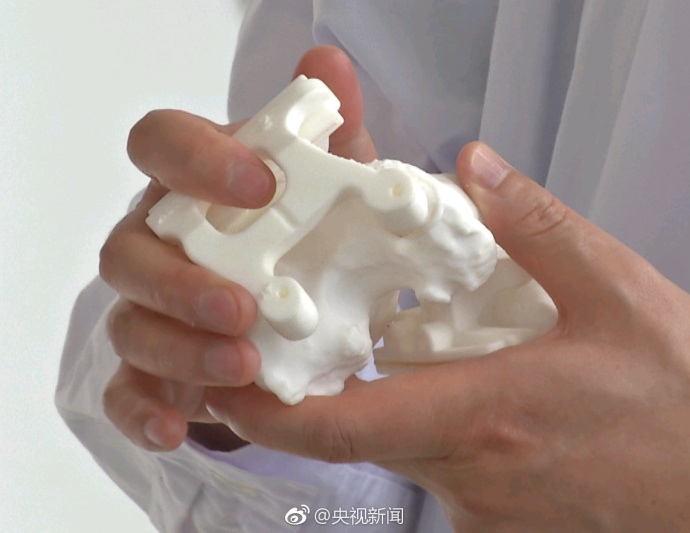 ����һ90��Ѫ�Ѳ����߳ɹ��û�3D��ӡϥ�ؽ�