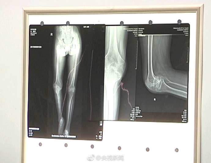 ����һ90��Ѫ�Ѳ����߳ɹ��û�3D��ӡϥ�ؽ�