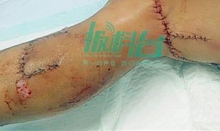 外卖小哥火场救出孩童负伤 孩童家属拒付小哥医药费