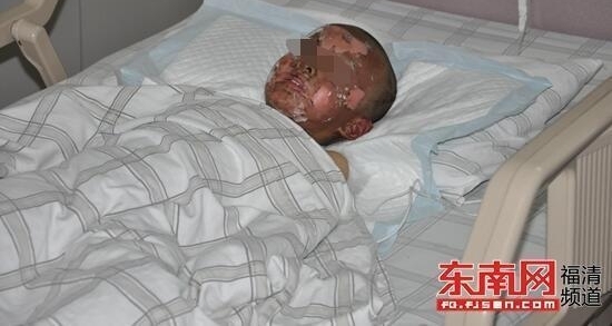 福清两市民严重烧伤 医药费愁煞家人