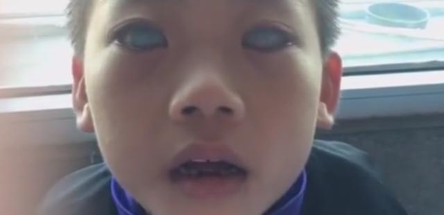 8岁“鬼眼”少年刘云峰,看到他的经历让人流泪!