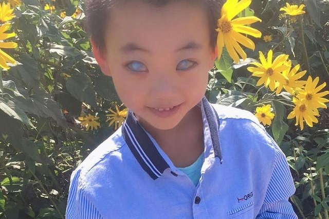 8岁“鬼眼”少年刘云峰,看到他的经历让人流泪!