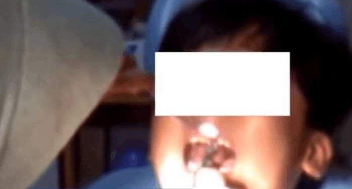 孩子患上口腔癌舌头被切除 只因家长常常给孩子吃这个