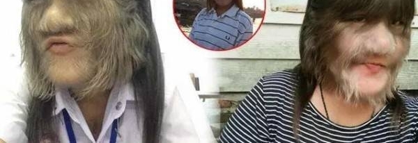 泰国毛脸小女孩长大了,脸上无毛,还有了陪伴的人
