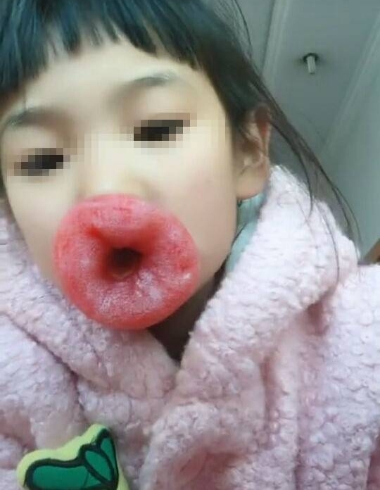 小女孩被逼做一事后嘴唇奇肿无比,真相让人捧腹大笑却又担忧不已