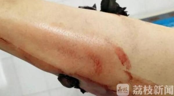 小腿贯穿伤 医院开启绿色通道紧急救治