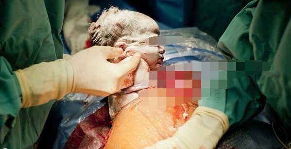 孕妇产下顺胞胎后,对医生说:想看宝宝,但眼睛睁不开,很想睡觉