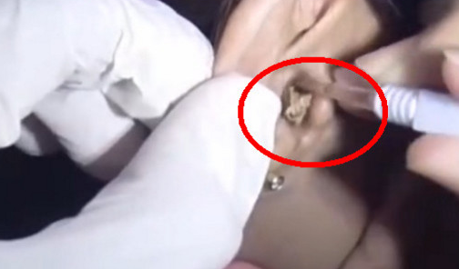 女子10年没挖耳屎,突然奇痒无比,结果挖出的东西让人大开眼界