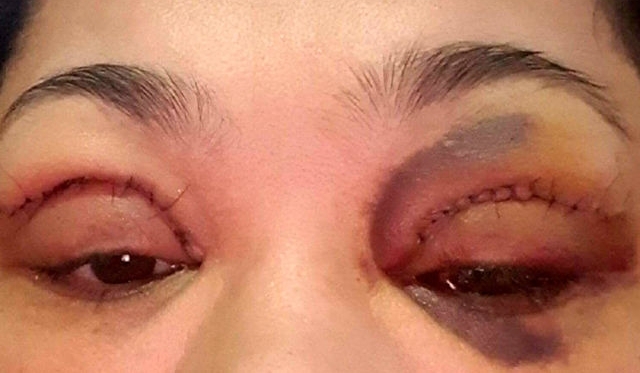 ����������˫��Ƥ��2�º��۾�������Ѫ���ף���֪����ҽ�����ĵ�