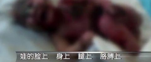 1岁女童全身烫锛偸祜紓差点没命!竟因家长没注意这件事