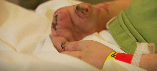 男子感染罕见流感并发症 被迫截去双脚和 9 根手指