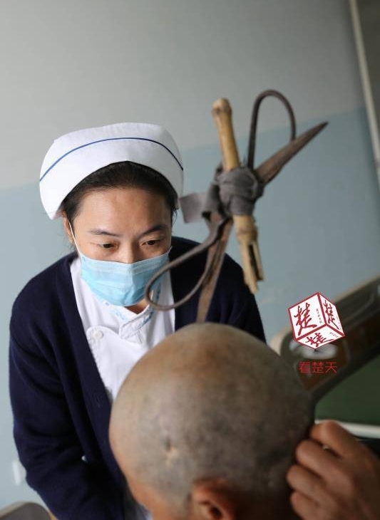 女子颅骨插进剪刀 不慌不忙坐公交就医