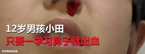 一上课就出鼻血,男孩1天流20多次鼻血无奈休学,医生却这样说