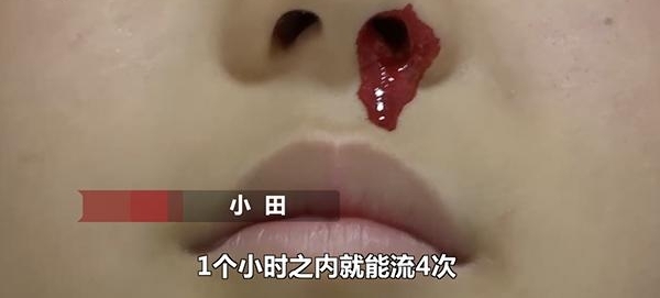 一学习就流鼻血!12岁男孩一天流20多次无奈休学