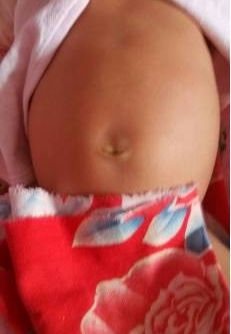 出生10天女婴肚子胀鼓鼓,医生开腹手术后又剖出两娃
