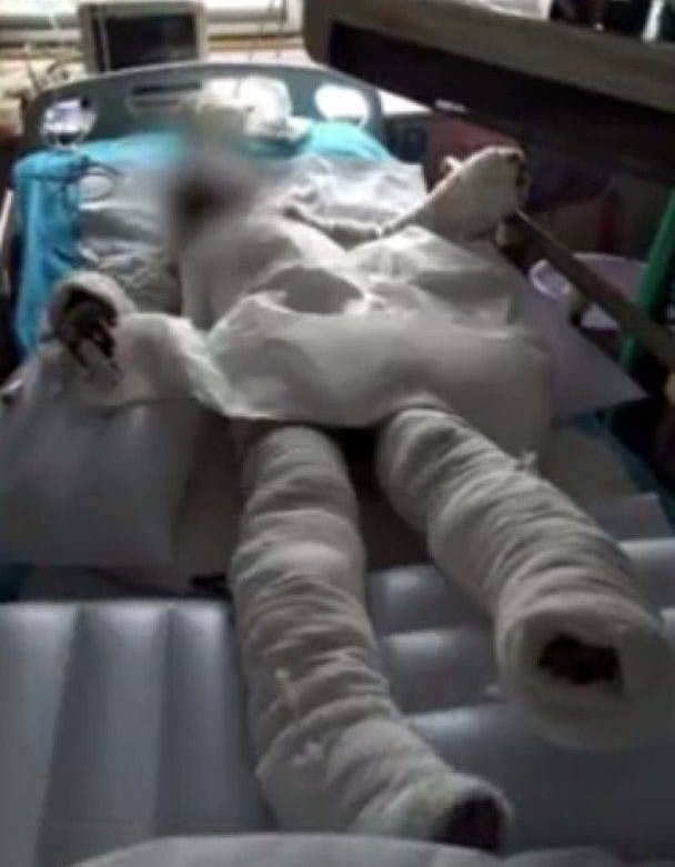 吓人!天然气泄漏传异味,张家界8岁女童用打火机照明引发爆燃!