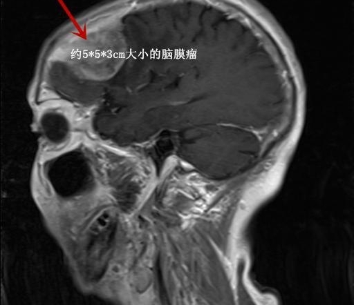 湖南八旬老人颅内巨大肿瘤,手术后医生用 3D 打印技术修补颅骨