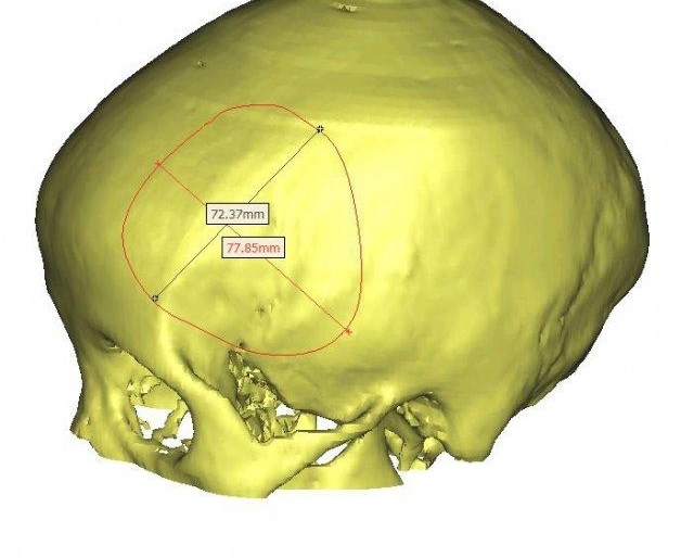 湖南八旬老人颅内巨大肿瘤,手术后医生用 3D 打印技术修补颅骨