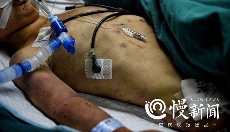 因为儿子没有给生活费 重庆垫江5岁男孩被亲奶奶毒打致昏迷