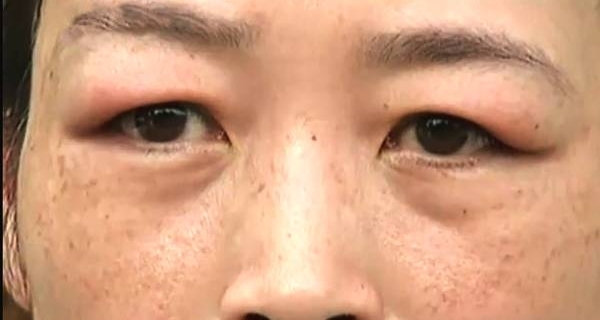 看眼却被填“夫妻宫”,离婚后额头出现大量肿包,医院:找卫生局