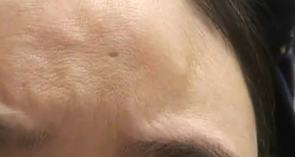 看眼却被填“夫妻宫”,离婚后额头出现大量肿包,医院:找卫生局