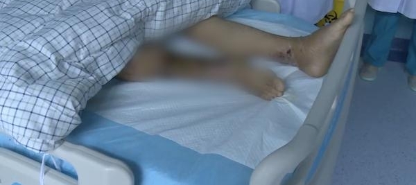 中年大叔被皮皮虾刺了下手指 下肢感染险丧命
