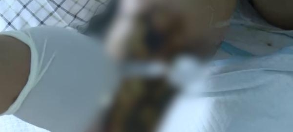 中年大叔被皮皮虾刺了下手指 下肢感染险丧命