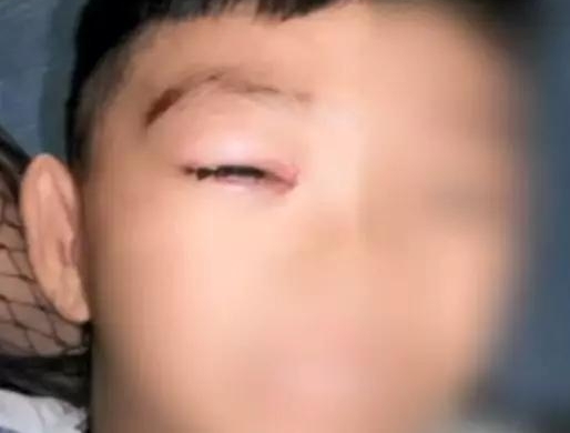 6岁男童被狗咬13天后去世 离打第四针狂犬疫苗差两天