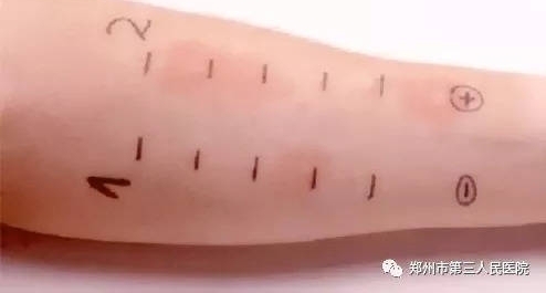 ����Ժ�����ա�Ƥ�����Ƿ���������ȥ��һ�����ԭ��