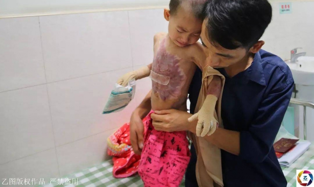 女子信习俗,坐月子泡药水澡,刚转身2岁女儿就跌进开水盆,崩溃
