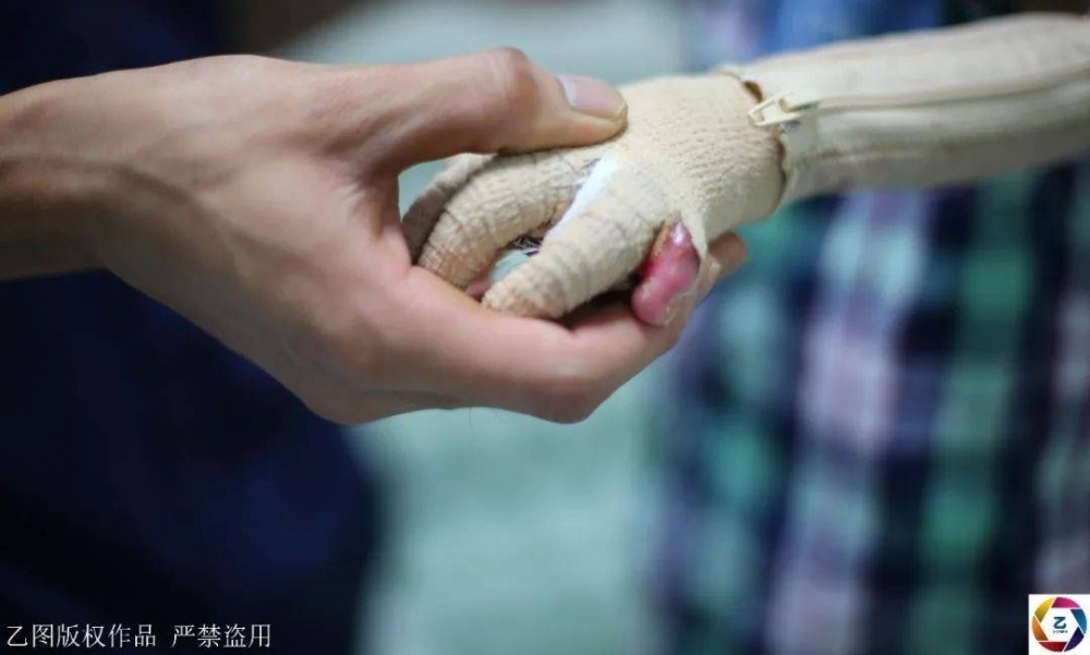 女子信习俗,坐月子泡药水澡,刚转身2岁女儿就跌进开水盆,崩溃