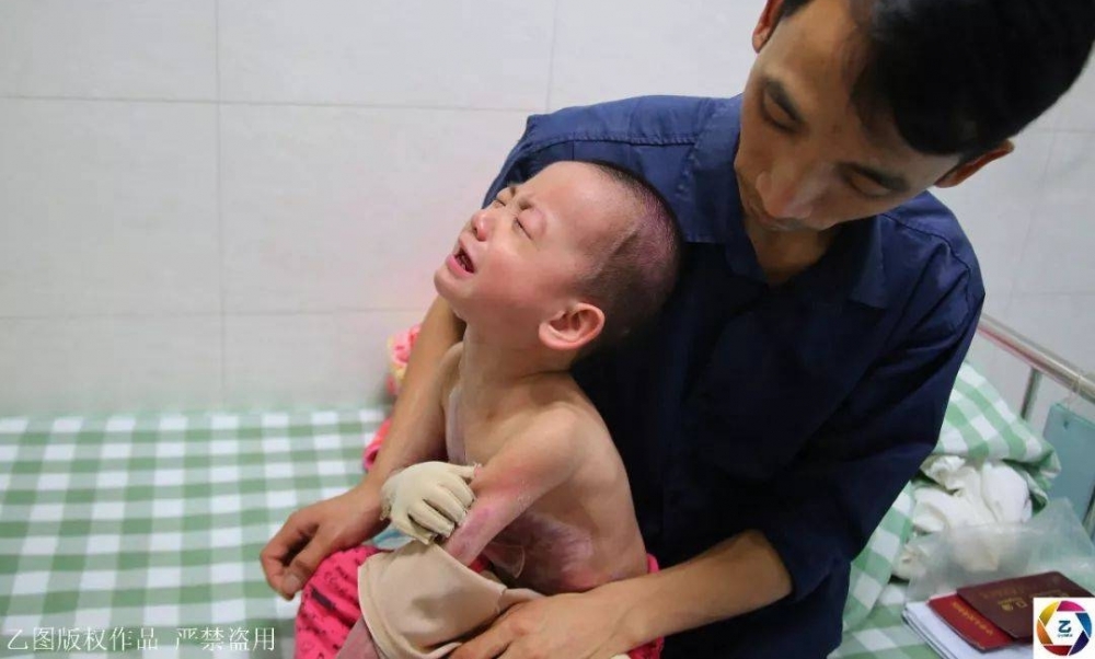 女子信习俗,坐月子泡药水澡,刚转身2岁女儿就跌进开水盆,崩溃