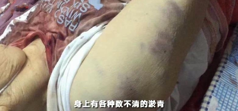 Ҿ徣83˱ķסԺ ֻΪƵҹ