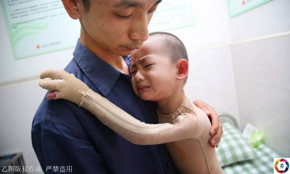 女子信习俗,坐月子泡药水澡,刚转身2岁女儿就跌进开水盆,崩溃