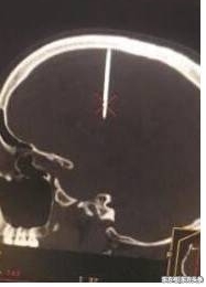 ����Ī��ͷ�ۣ�ȥ���ԭ���������������һ��5���׶��ӣ�
