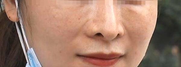 女子花9万取肋骨垫鼻, 整完之后却不满意了: 女儿说我是怪物