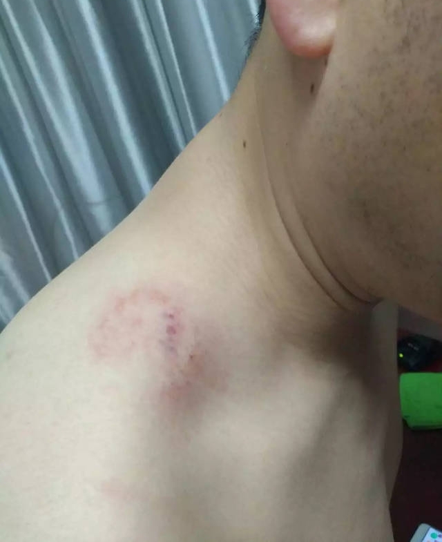 ��ҹ���Ϸ�һλ���챻ҧ�ˣ�ֻ��Ϊ����(��Ƶ)